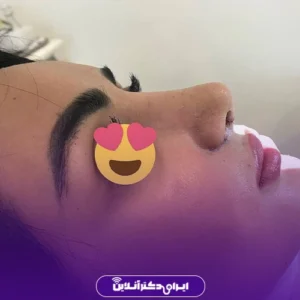 نمونه کار عمل بینی دکتر مهرداد امیرآبادی شیراز 4