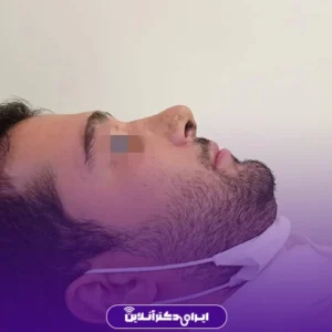 نمونه کار عمل بینی دکتر مهرداد امیرآبادی شیراز 6