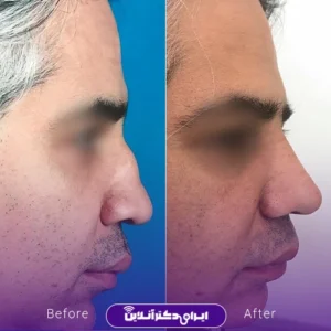 نمونه کار عمل بینی دکتر مهرداد امیرآبادی شیراز 8