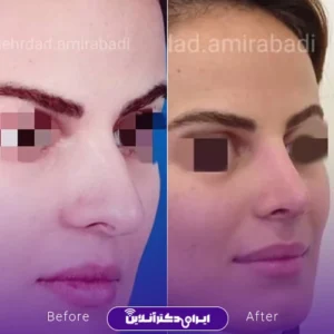 نمونه کار عمل بینی دکتر مهرداد امیرآبادی شیراز 9