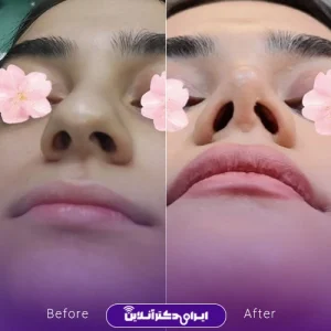 نمونه کار عمل بینی دکتر داوود محمدیان روشن 1