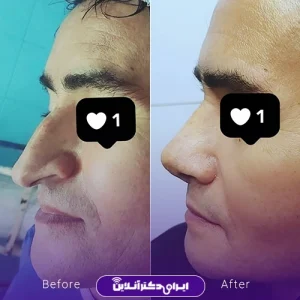 نمونه کار عمل بینی دکتر داوود محمدیان روشن 10
