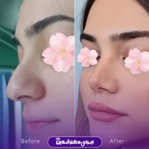 نمونه کار عمل بینی دکتر داوود محمدیان روشن 2