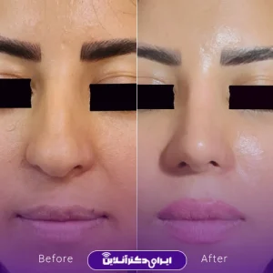 نمونه کار عمل بینی دکتر داوود محمدیان روشن 3
