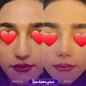 نمونه کار عمل بینی دکتر داوود محمدیان روشن 4