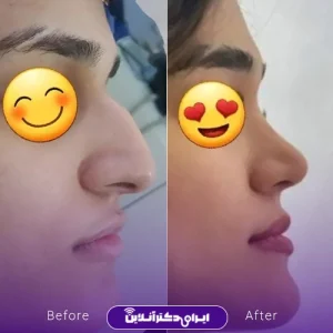 نمونه کار عمل بینی دکتر داوود محمدیان روشن 5