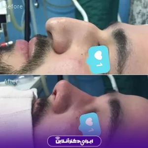 نمونه کار عمل بینی دکتر داوود محمدیان روشن 6