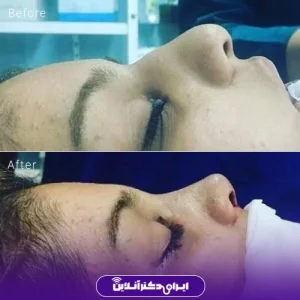 نمونه کار عمل بینی دکتر داوود محمدیان روشن 8