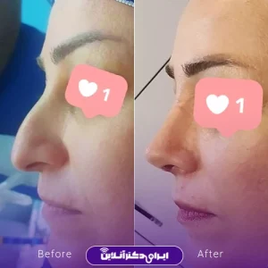 نمونه کار عمل بینی دکتر داوود محمدیان روشن 9