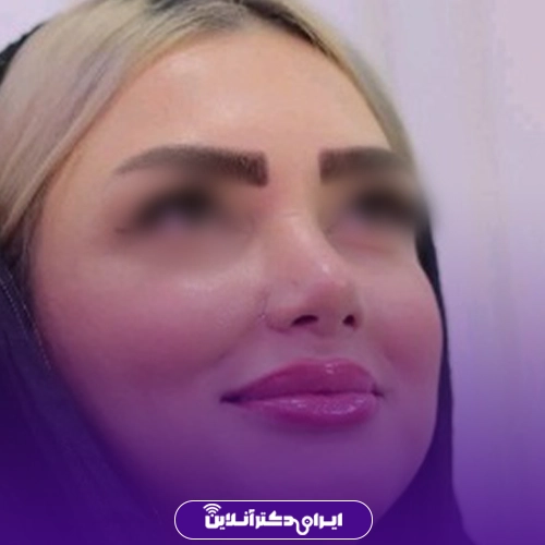 نمونه کار عمل بینی گوشتی خانم توسط دکتر فرشته عبدالمطلبی در کرج