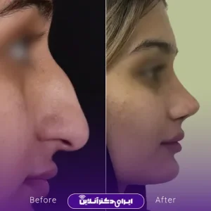 نمونه کار عمل بینی دکتر ادیب ملایی 1