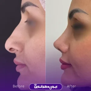 نمونه کار عمل بینی دکتر ادیب ملایی 10