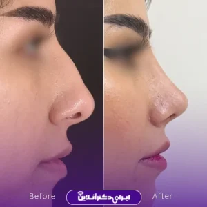 نمونه کار عمل بینی دکتر ادیب ملایی 15