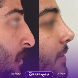 نمونه کار عمل بینی دکتر ادیب ملایی 17