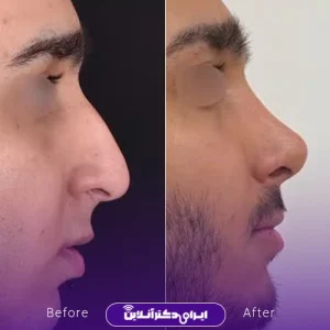 نمونه کار عمل بینی دکتر ادیب ملایی 19