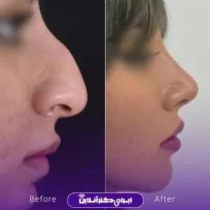 نمونه کار عمل بینی دکتر ادیب ملایی 2