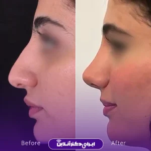 نمونه کار عمل بینی دکتر ادیب ملایی 3