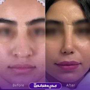 نمونه کار عمل بینی دکتر ادیب ملایی 4