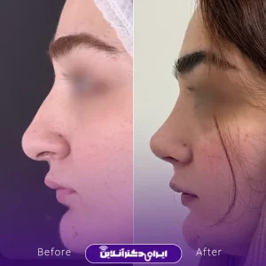 نمونه کار عمل بینی دکتر ادیب ملایی 5