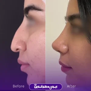 نمونه کار عمل بینی دکتر ادیب ملایی 6