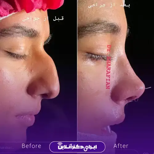 بهترین جراح بینی مردانه در تهران + لیست ۱۰ مورد از بهترین جراحان 133 نمونه کارهای عمل بینی مردانه دکتر آرش شرفیان 1