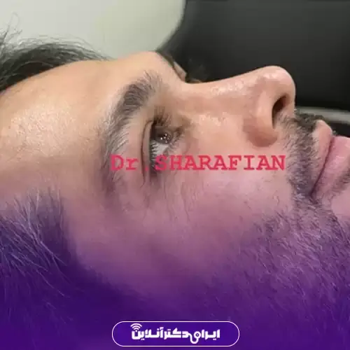 بهترین جراح بینی مردانه در تهران + لیست ۱۰ مورد از بهترین جراحان 136 نمونه کارهای عمل بینی مردانه دکتر آرش شرفیان 4