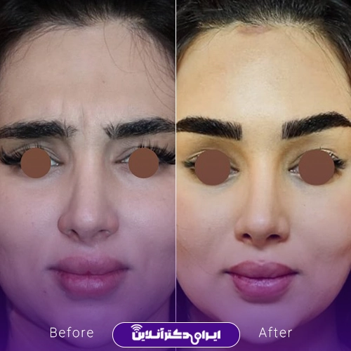 بهترین جراح انحراف بینی در اصفهان + لیست 9 مورد از بهترین جراحان 108 نمونه کار عمل انحراف بینی دکتر عمرانی فرد اصفهان 1