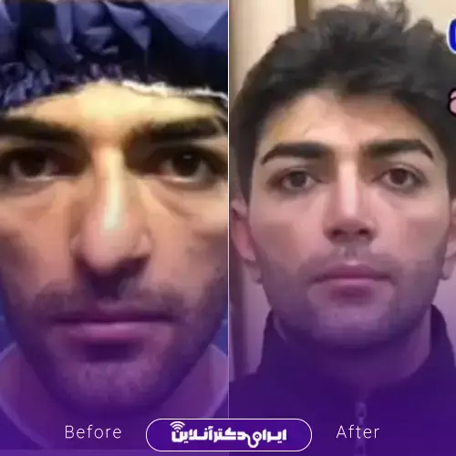بهترین جراح بینی مردانه در تهران + لیست ۱۰ مورد از بهترین جراحان 113 نمونه کارهای عمل بینی مردانه دکتر خسرو مقتدر 1