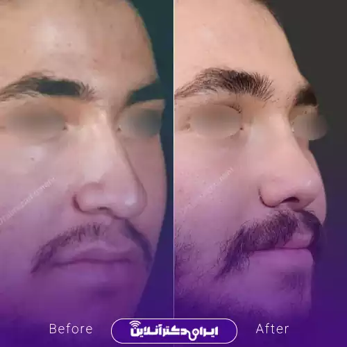 بهترین جراح انحراف بینی در اصفهان + لیست 9 مورد از بهترین جراحان 86 نمونه قبل و بعد عمل انحراف بینی دکتر علیرضا مومنی 1