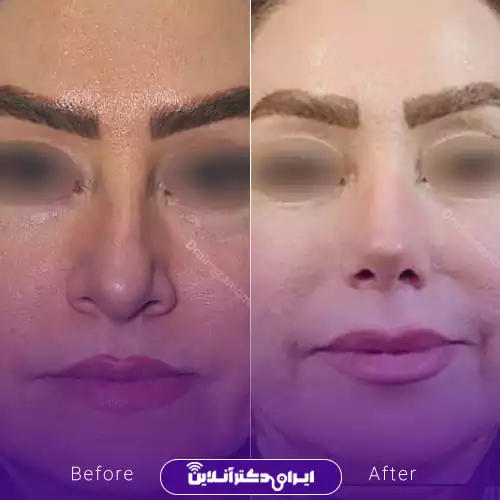 بهترین جراح انحراف بینی در اصفهان + لیست 9 مورد از بهترین جراحان 88 نمونه قبل و بعد عمل انحراف بینی دکتر علیرضا مومنی 3