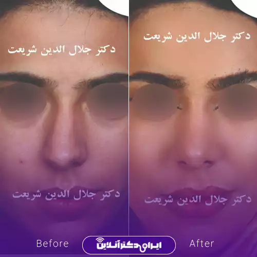 بهترین جراح انحراف بینی در اصفهان + لیست 9 مورد از بهترین جراحان 74 نمونه کار عمل انحراف بینی دکتر جلال الدین شریعت 1