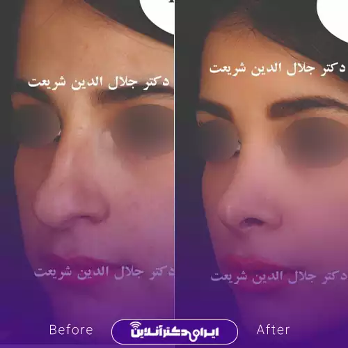 بهترین جراح انحراف بینی در اصفهان + لیست 9 مورد از بهترین جراحان 75 نمونه کار عمل انحراف بینی دکتر جلال الدین شریعت 2