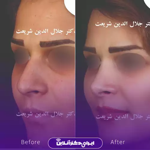 بهترین جراح انحراف بینی در اصفهان + لیست 9 مورد از بهترین جراحان 76 نمونه کار عمل انحراف بینی دکتر جلال الدین شریعت 3