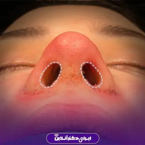 عمل بینی به روش اروپایی؛ عمل بینی اروپایی به چه صورتهایی میاد؟ 8 ویژگیهای ظاهری بینی اروپایی برای پرهها و سوراخهای بینی