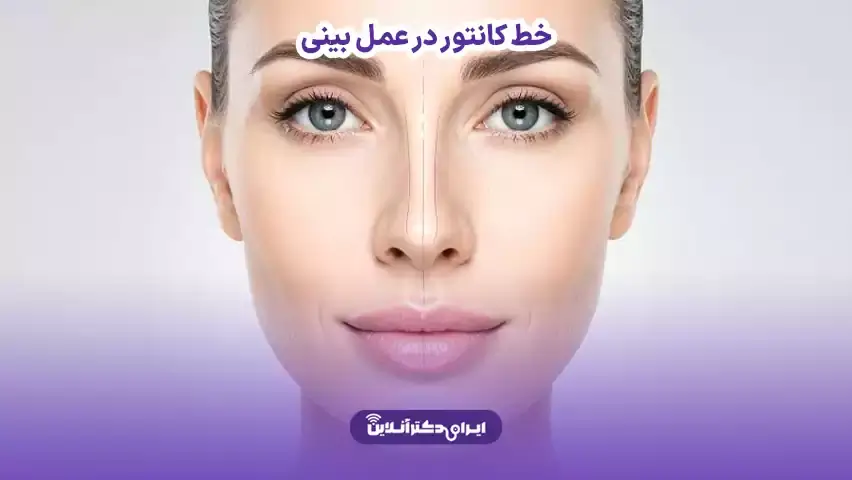 ایران دکتر آنلاین | ویزیت و مشاوره آنلاین 53 خط کانتور در عمل بینی