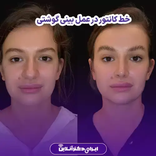 خط کانتور در عمل بینی کی مشخص میشود؟ 5 خط کانتور در عمل بینی گوشتی
