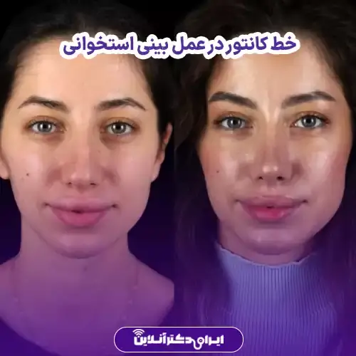 خط کانتور در عمل بینی کی مشخص میشود؟ 4 خط کانتور در عمل بینی استخوانی