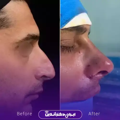 بهترین جراح بینی مردانه در تهران + لیست ۱۰ مورد از بهترین جراحان 104 نمونه کارهای عمل بینی مردانه دکتر ابوالفضل عباس زاده 2