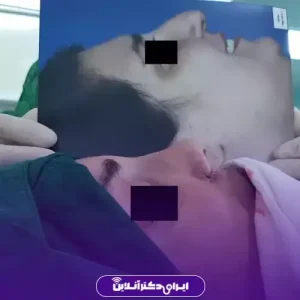 نمونه کار عمل بینی دکتر علی حیدری معاف 5