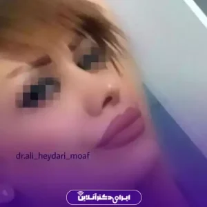 نمونه کار عمل بینی دکتر علی حیدری معاف 8