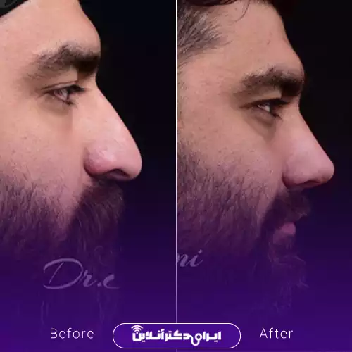 بهترین جراح بینی مردانه در تهران + لیست ۱۰ مورد از بهترین جراحان 91 نمونه قبل و بعد عمل بینی مردانه دکتر علی جاودانی