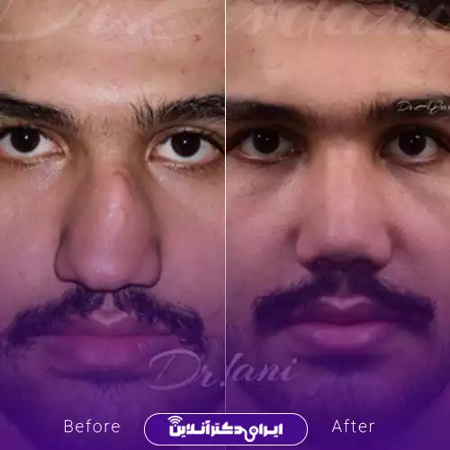 بهترین جراح بینی مردانه در تهران + لیست ۱۰ مورد از بهترین جراحان 92 نمونه قبل و بعد جراحی بینی مردانه دکتر علی جاودانی در تهران