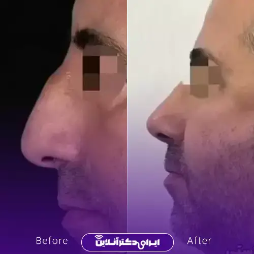 بهترین جراح بینی مردانه در تهران + لیست ۱۰ مورد از بهترین جراحان 128 نمونه کارهای عمل بینی مردانه دکتر علی میقانی 1
