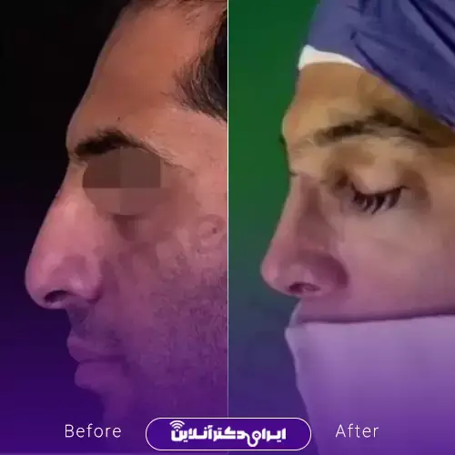 بهترین جراح بینی مردانه در تهران + لیست ۱۰ مورد از بهترین جراحان 131 نمونه کارهای عمل بینی مردانه دکتر علی میقانی 4