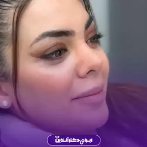 نمونه کار عمل بینی دکتر امیر بیاتیان 4