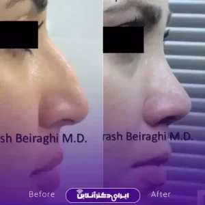 نمونه کار عمل بینی دکتر آرش بیرقی طوسی 10