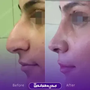نمونه کار عمل بینی دکتر آرش بیرقی طوسی 5