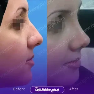 نمونه کار عمل بینی دکتر آرش بیرقی طوسی 7