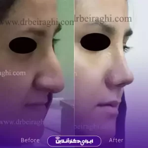 نمونه کار عمل بینی دکتر آرش بیرقی طوسی 8