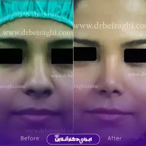 نمونه کار عمل بینی دکتر آرش بیرقی طوسی 9